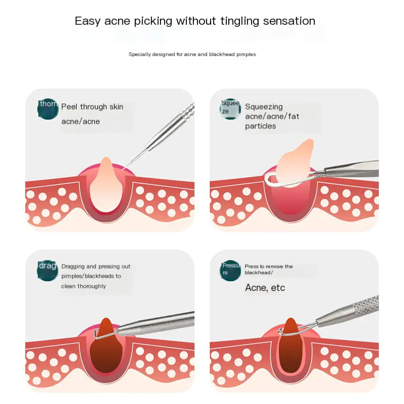 Precision Pimple Extraction Tool Set for Beauty Salons